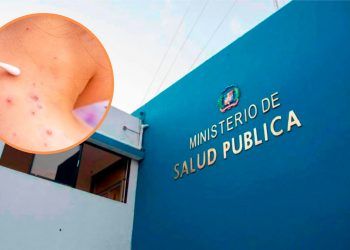Salud Pública anuncia nuevos casos de viruela del mono en RD 