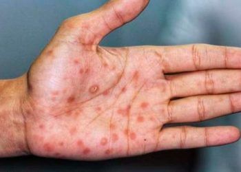 Nuevo caso de viruela del mono está aislado y bajo tratamiento