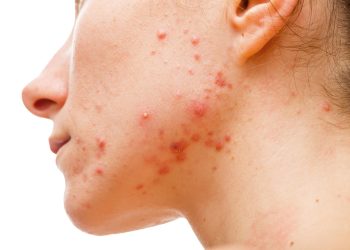 Salud Pública alerta sobre tratamientos de acné de La Roche-Posay