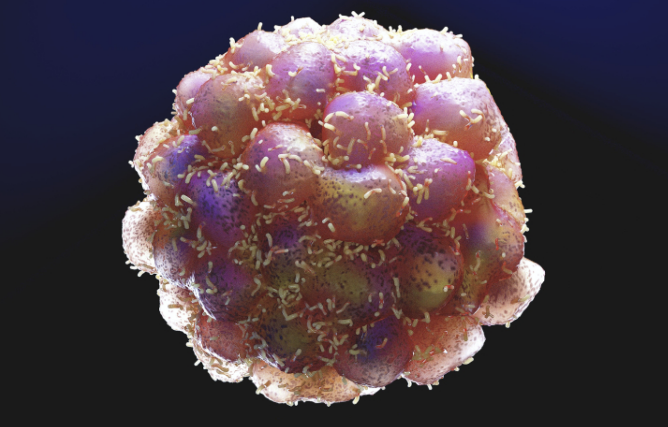 Descubren proteína en metástasis de Cáncer de Mama: ¡se puede frenar con medicamentos!